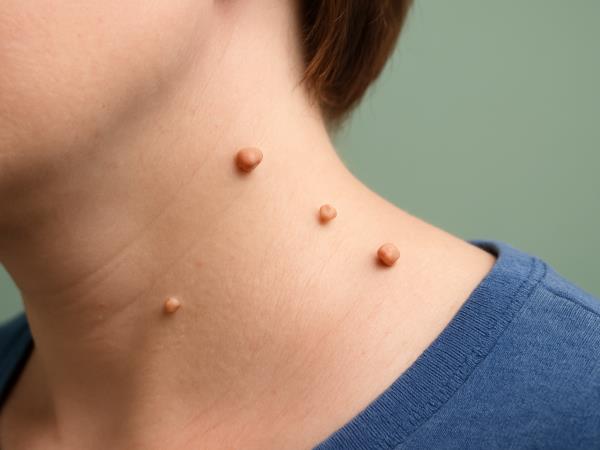 Kako odstraniti bradavice s kože?