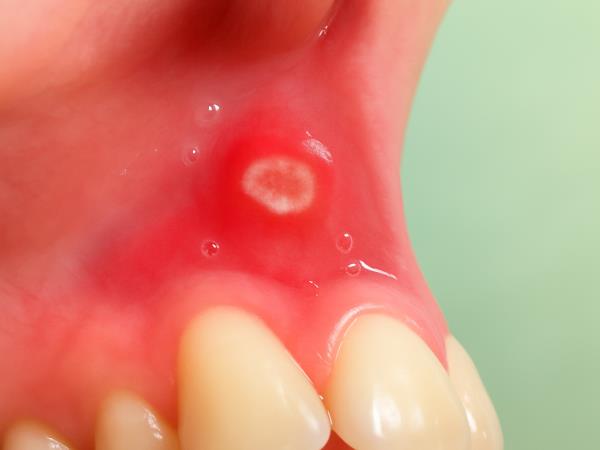 Kako ozdraviti afte v ustni votlini