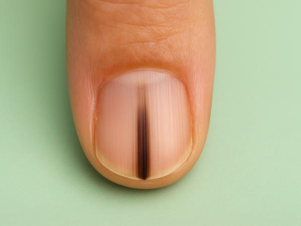 Če se vam to pojavi pod nohtom, je čas za ukrepanje