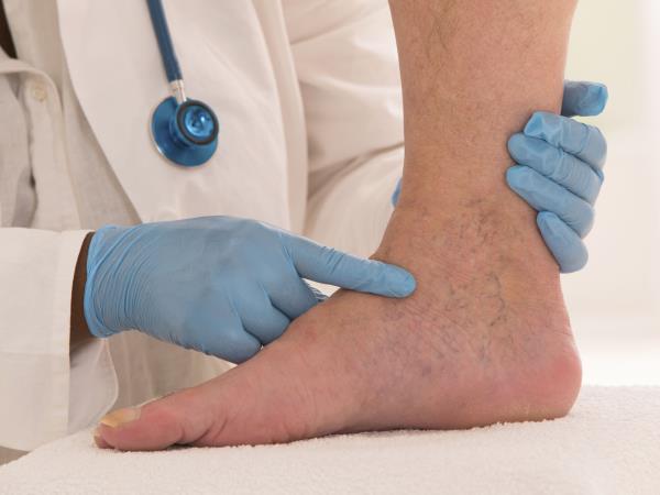 Domače rešitve proti krčnim žilam