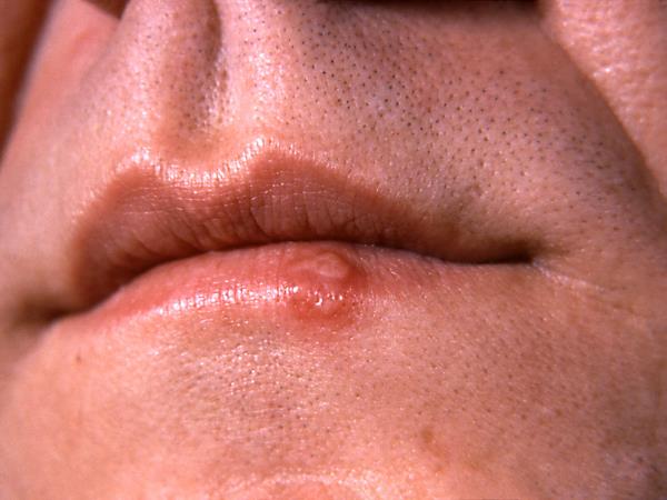 Herpes na ustnici? Čebula, med in sol so že čakali v vaši kuhinji