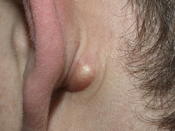 Kako po naravni poti odstraniti bulice zamaščenih lojnic