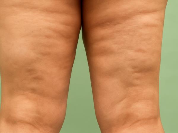 Naj vas ne bo strah zaradi celulita stopiti na plažo