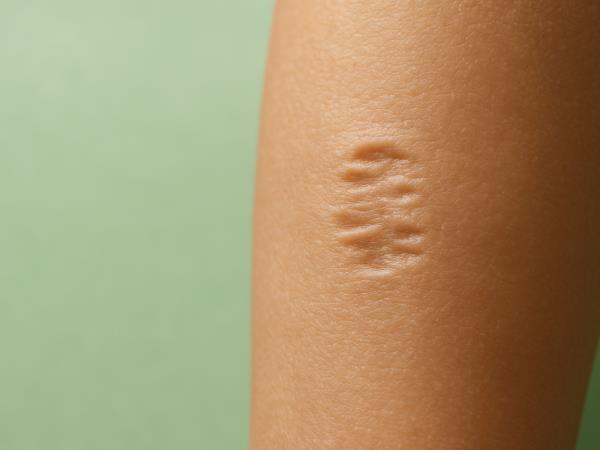 Ta brazgotina na roki ni naključje – ve, kaj si preživel