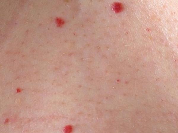Imate rdeče pike na koži? Preverite za kaj gre in ali so nevarne