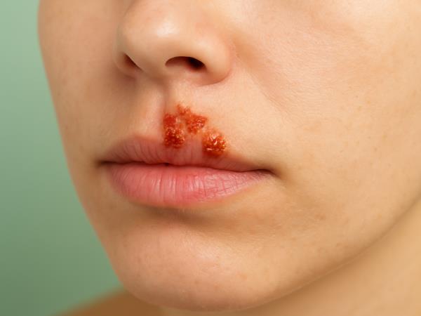 Zdravilo proti herpesu, ki ga ima vsak doma