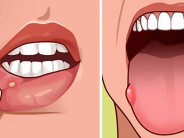 Kako prepoznati, da vam primanjkuje folne kisline