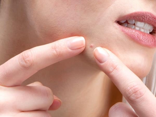 Mozolji po obrazu so rezultat hrane. Veste katere?