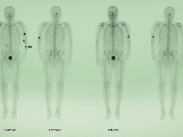 Rak ni nevaren, nevarne so metastaze