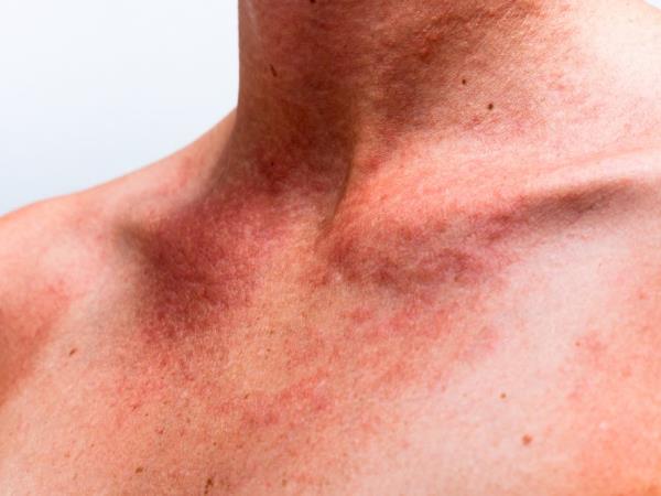 Ko UV indeks preseže 10, sonce ni več prijatelj – postane sovražnik