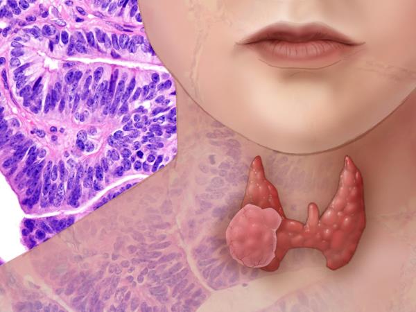 Bolezni ščitnice so lahko vzrok za kronično utrujenost