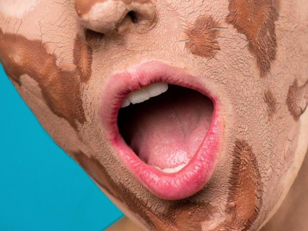 Zdravje kože: 5 najslabših živil