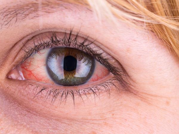 Rdeče oči: kaj nam sporočajo?