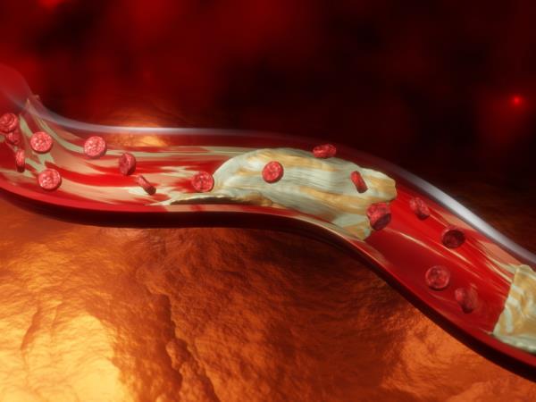 4 skriti znaki zamašenih arterij