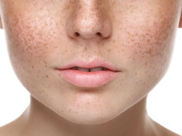 Preprost recept, kako odstraniti starostne pege