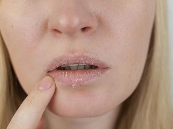 Suha usta: znak žeje ali opozorilo na večjo težavo?