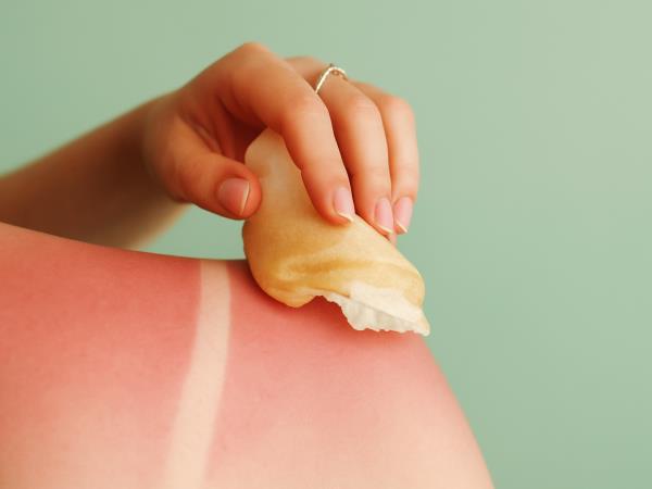 Sonce vas je opeklo? Krompir, jogurt in kumare niso le za solato